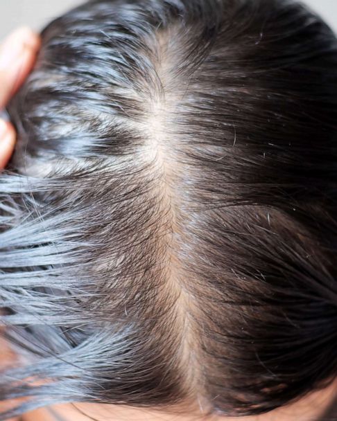 Brudgom Uskyld blanding 12 signs of hair loss to bring up to your dermatologist - Good Morning  America