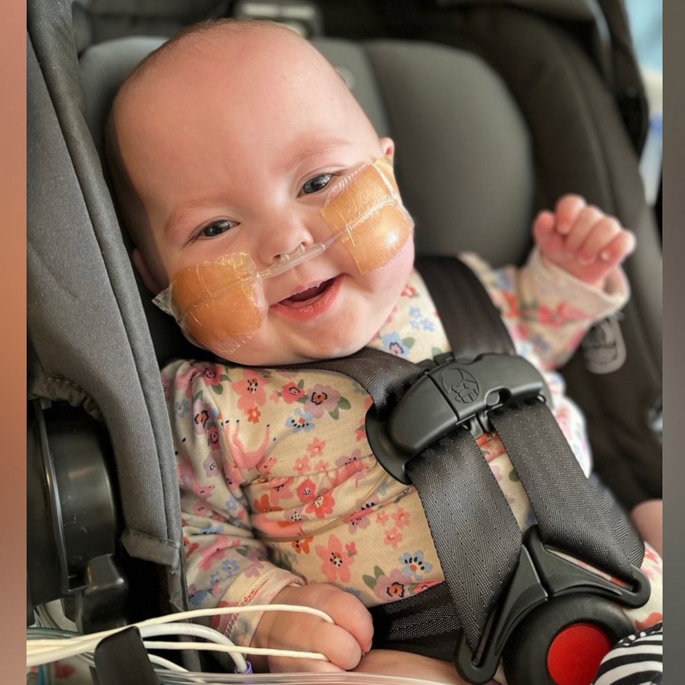 VIDEO: Doctors save baby with incomplete esophagus with surgery involving magnets