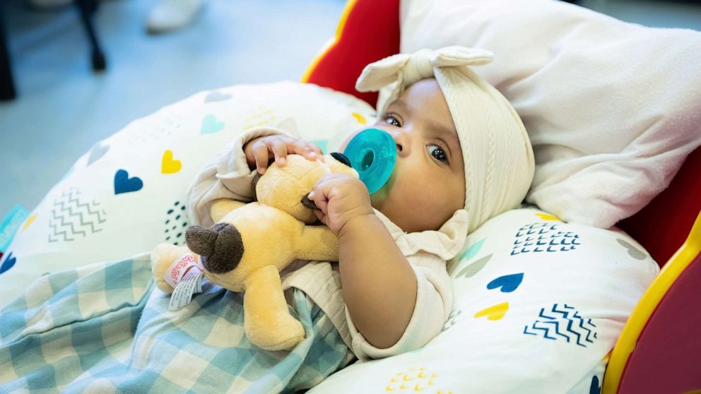 VIDEO: Conjoined 3-month-old twins undergo successful separation surgery