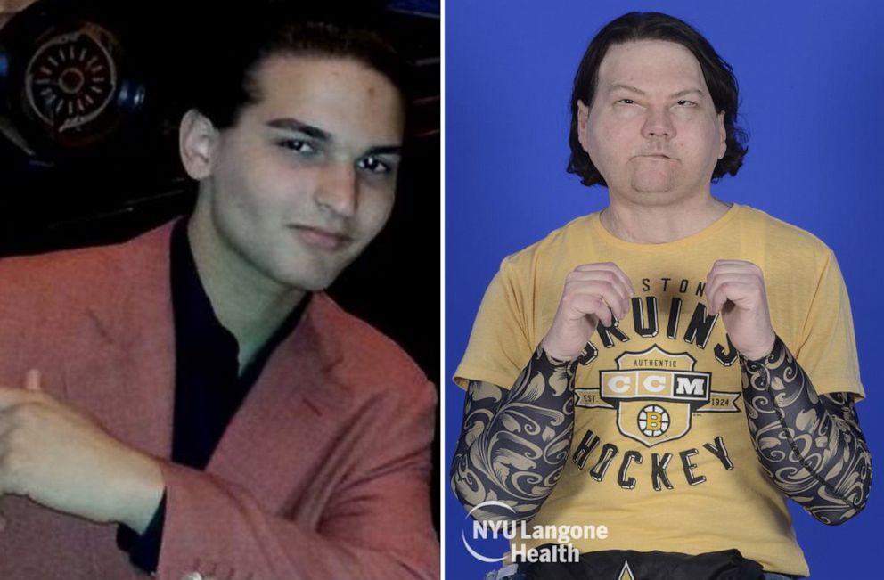PHOTO: Joe DiMeo, 22, is pictured before and during the recovery of his face and double hand transplant in images released by NYU Langone Health.