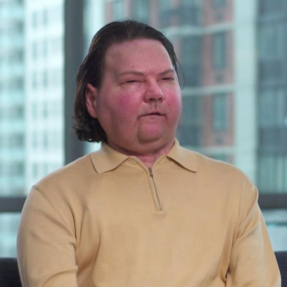 VIDEO: Man receives world’s first successful face and double hand transplant