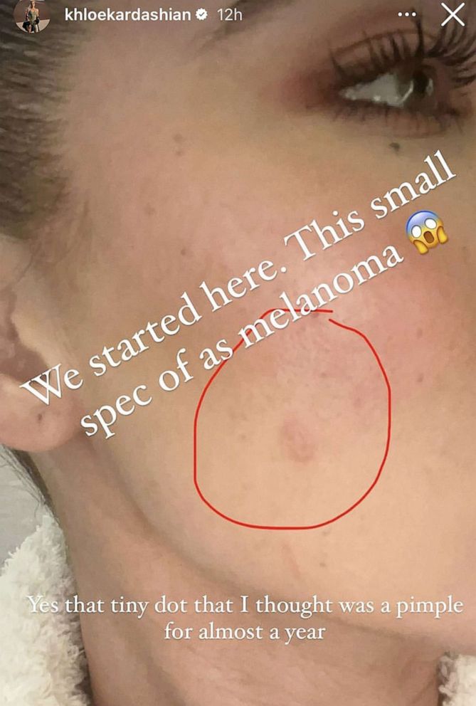 Kong Lear skuffet erfaring Khloe Kardashian shares before-and-after photos of melanoma battle - ABC  News