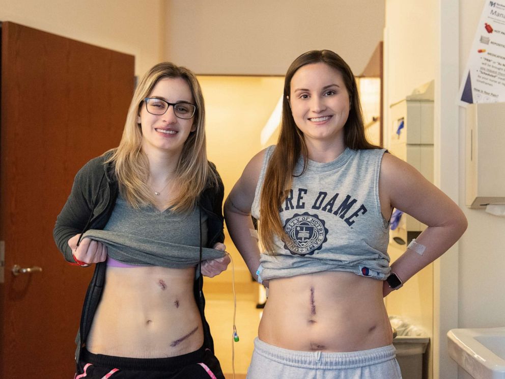 PHOTO: In this undated photo, Bethany and Hannah Goralski are shown prior to their kidney donation surgery.