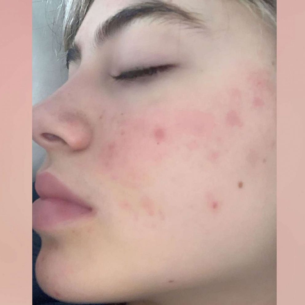 VIDEO: We put acne stickers to the test