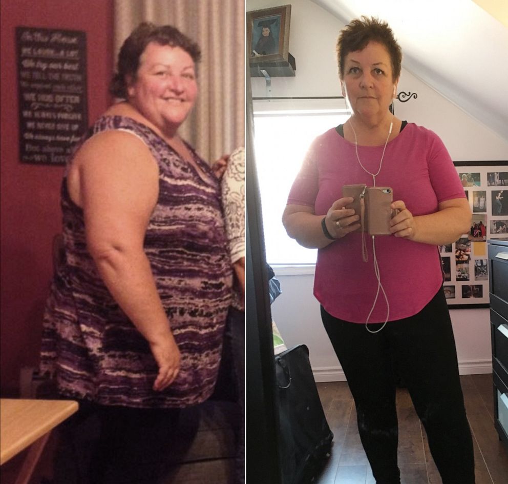 PHOTO: Lindy Cellucci, a 60-year-old retired teacher, lost 150 pounds.