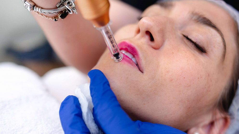 PHOTO: A woman receives hyaluronic acid cosmetic treatment on her lips in this stock image.