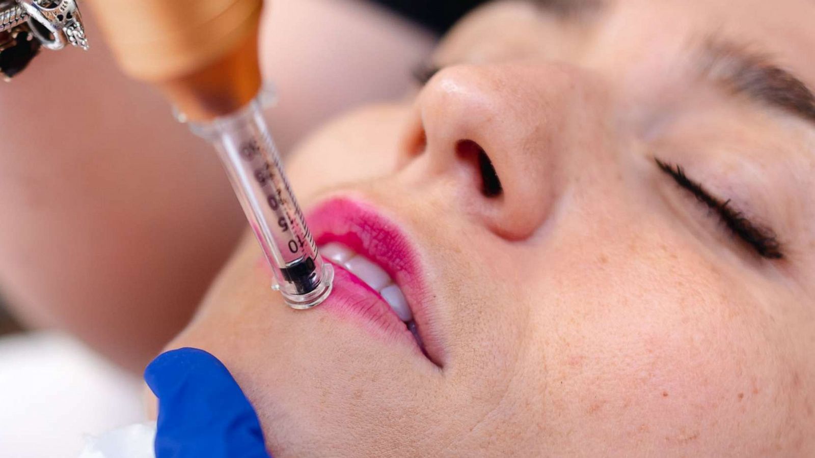 PHOTO: A woman receives hyaluronic acid cosmetic treatment on her lips in this stock image.