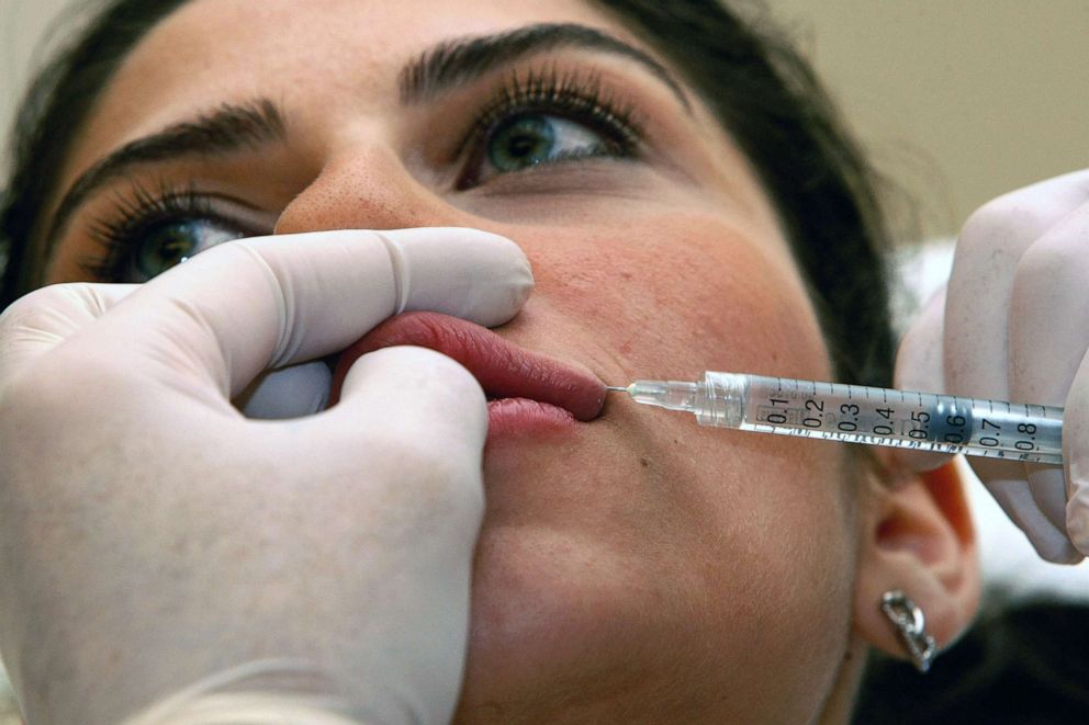 PHOTO: A plastic surgeon injects filler liquid into the lips of a patient at his clinic in Beirut, June 25, 2009. 