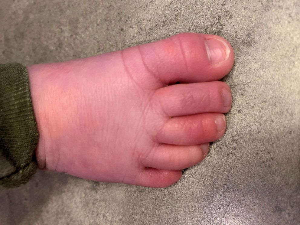 PHOTO: Sara Ward's 5-month-old Logan developed hair tourniquet syndrome in January and had to be rushed to the ER. This image shows his healed toe.