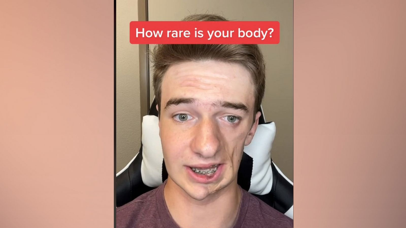 PHOTO: Lukas Caldwell, 19, uses social media to share his experience living with Parry-Romberg syndrome.