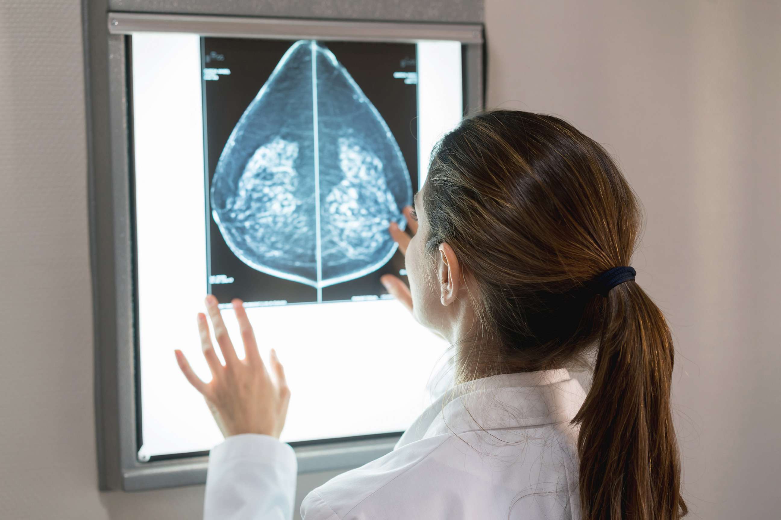 PHOTO: This stock image shows a doctor looking at her patient's mammogram.