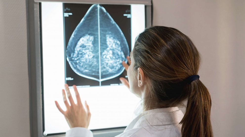 PHOTO: This stock image shows a doctor looking at her patient's mammogram.