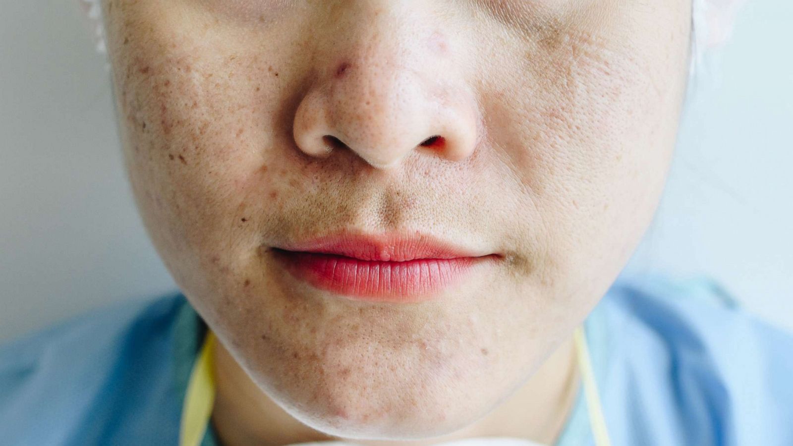 PHOTO: Stock photo of a woman with skin damage after wearing a face mask.