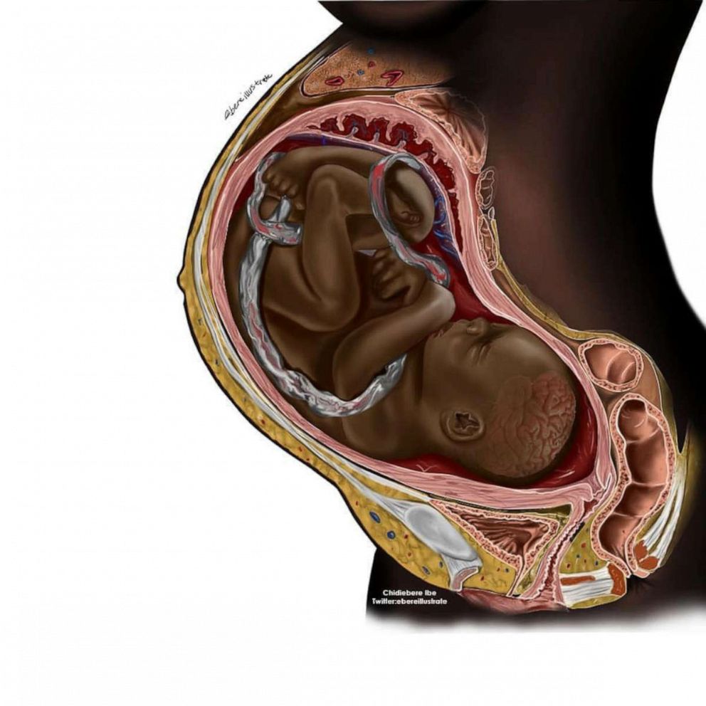 PHOTO: This medical illustration showing a Black pregnant woman went viral for promoting diversity.