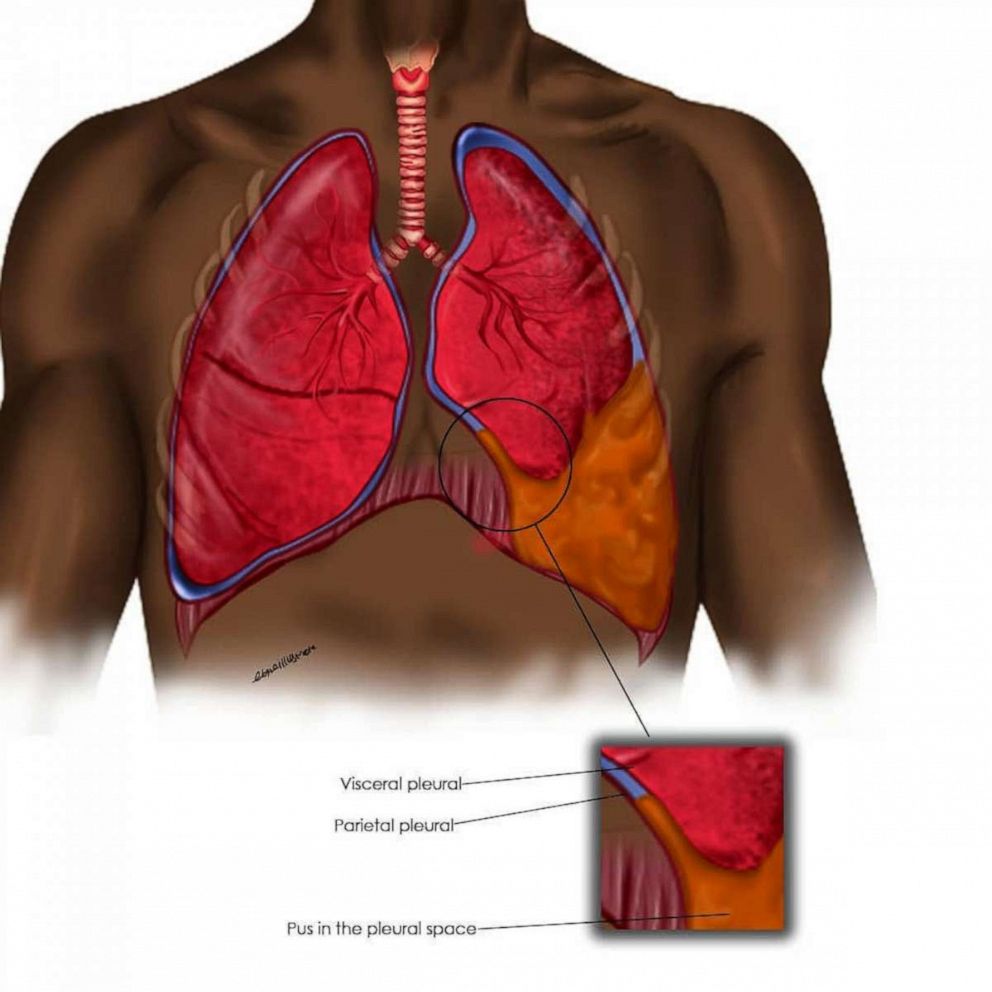 PHOTO: Medical illustration showing Emphyema Thoracis.