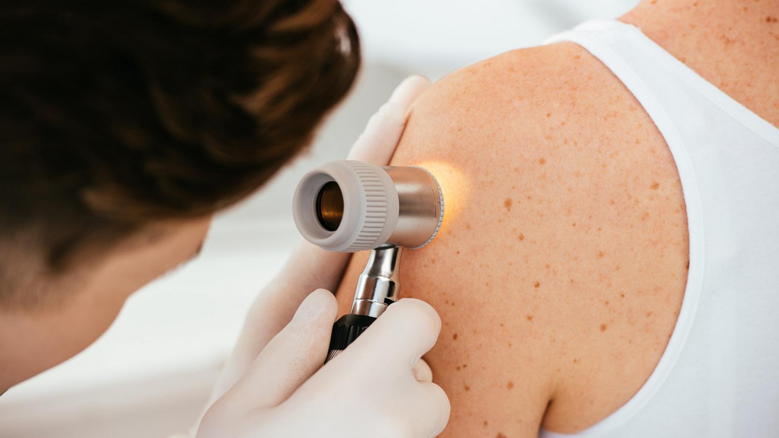 PHOTO: A dermatologist uses a dermatoscope while examining patient.