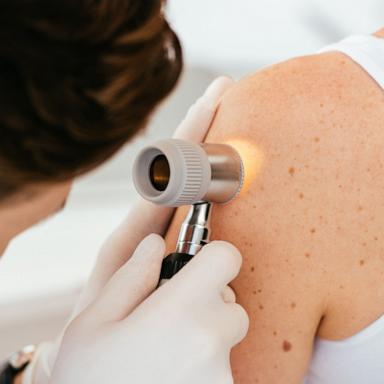PHOTO: A dermatologist uses a dermatoscope while examining patient.