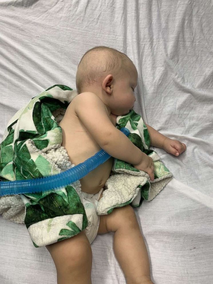 PHOTO: Antonio  DiGrigorio was admitted into Jersey Shore University Medical Center's pediatric intensive care unit for Respiratory syncytial virus, or RSV, when he was 8 months old.