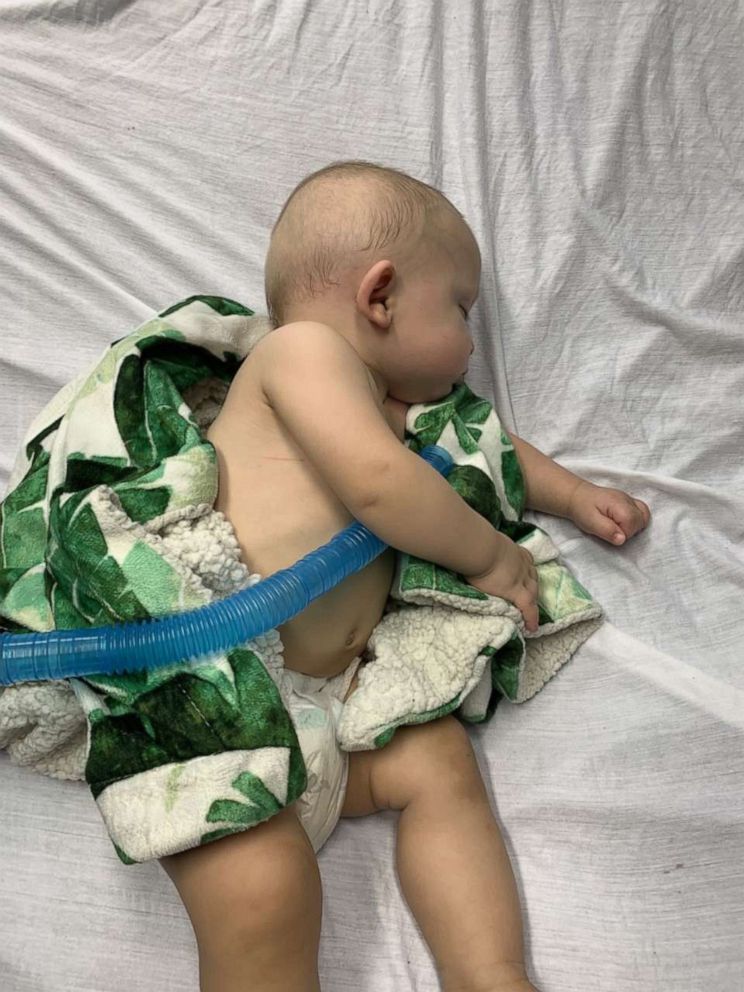 PHOTO: Antonio DiGrigorio was admitted into Jersey Shore University Medical Center's pediatric intensive care unit for Respiratory syncytial virus, or RSV, when he was 8 months old.