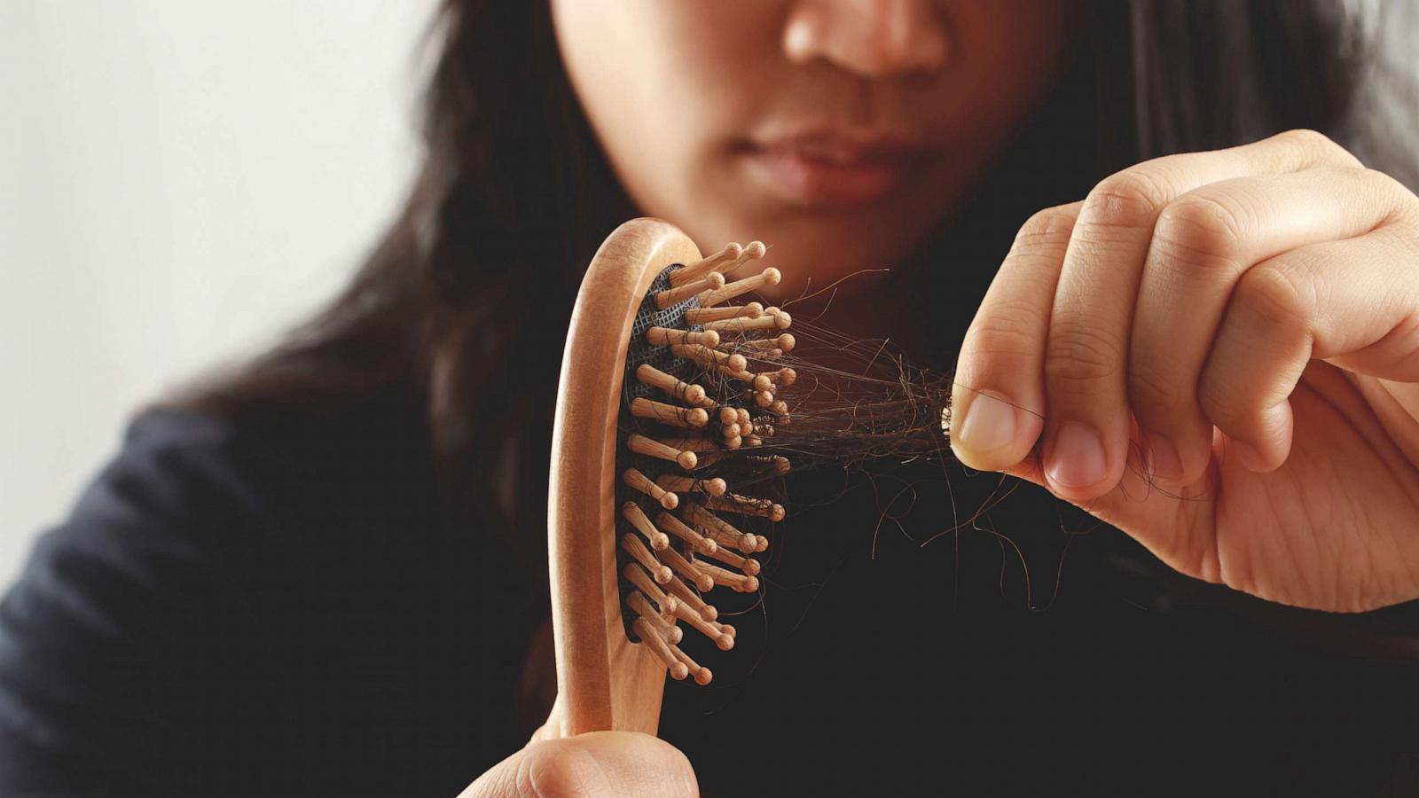 PHOTO: Young woman with hair loss.