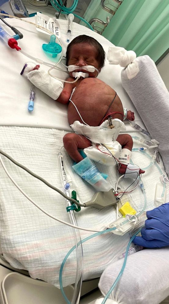 PHOTO: Max Do is pictured in a undated photo from during his hospital stay in Illinois. Max was discharged from the hospital on May 23 after 11 months in the NICU.