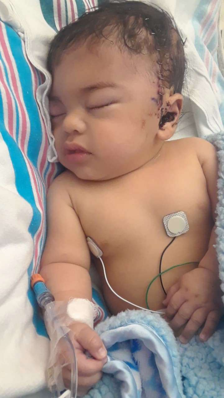 PHOTO: Noah Valdez is pictured in the hospital in Edinburg, Texas, after his surgery for craniosynostosis.