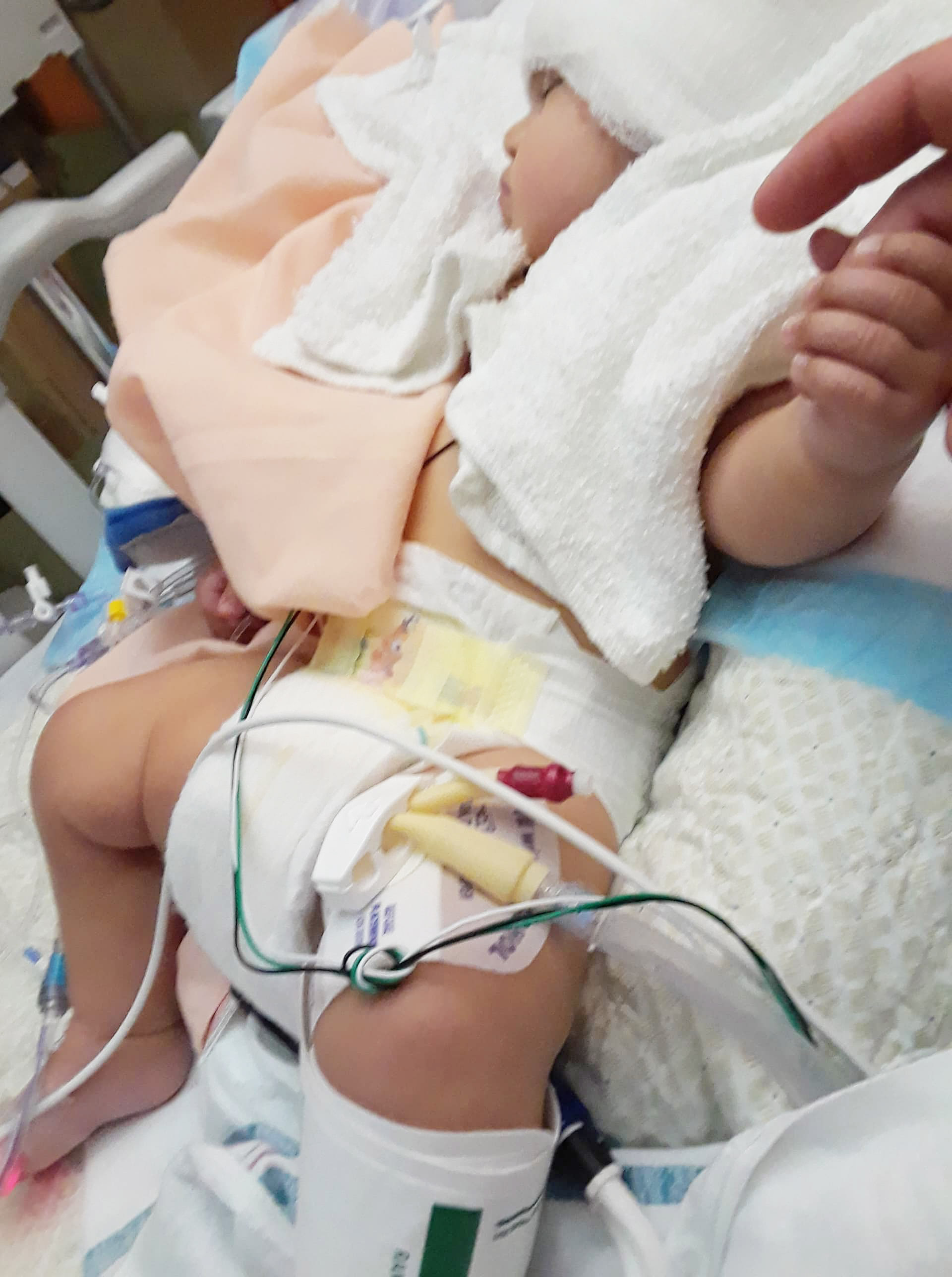 PHOTO: Noah Valdez is pictured in the hospital in Edinburg, Texas, where he had surgery for craniosynostosis.