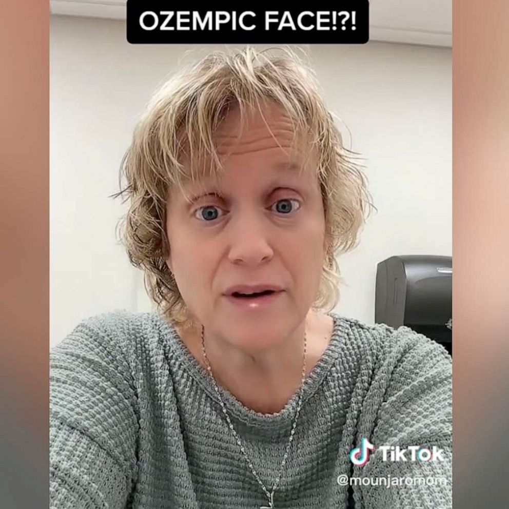 Destigmatizing Ozempic face