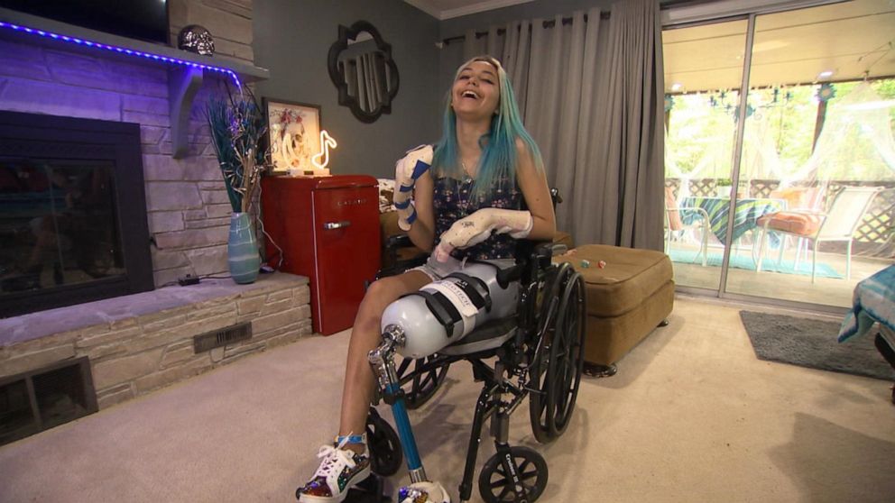 PHOTO: Paige Winter, 17, lost two fingers and her left leg was amputated. 