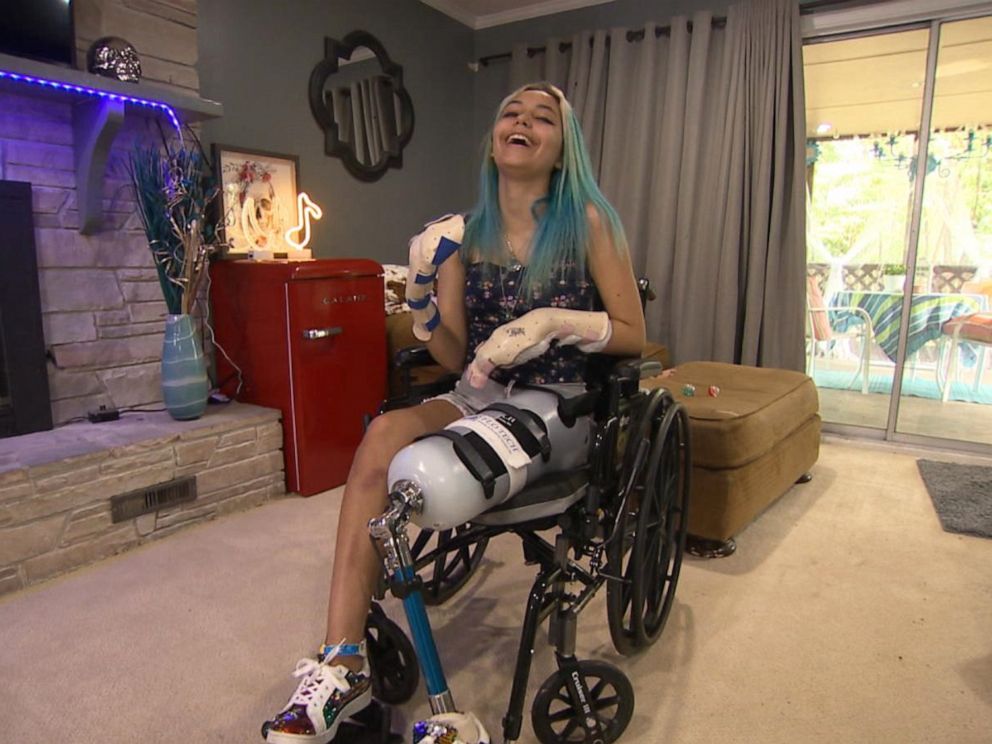 PHOTO: Paige Winter, 17, lost two fingers and her left leg was amputated.