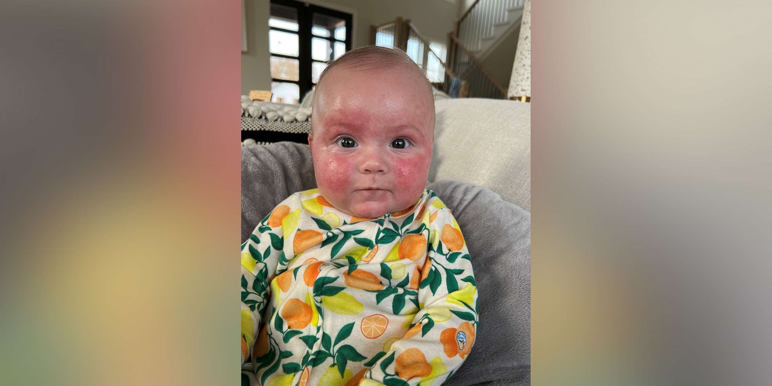 PHOTO: According to Weedman, Palmer gets a "severe" form of eczema after consuming milk protein, which can present as facial boils that then turn into scabs.