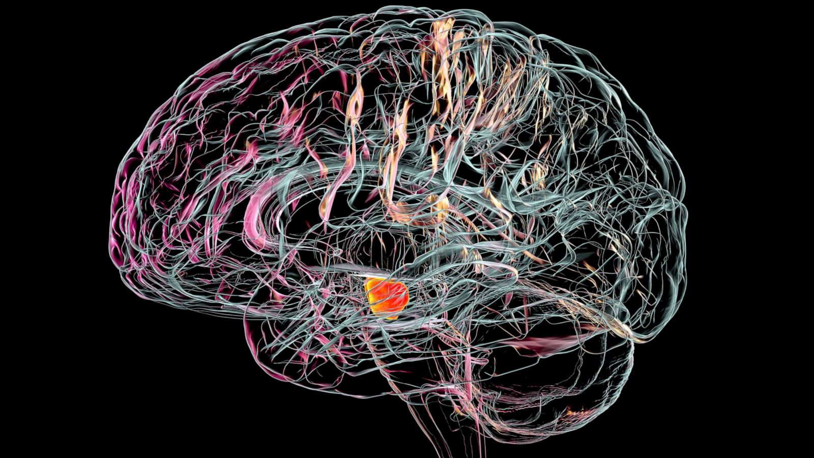 PHOTO: Illustration showing a healthy substantia nigra in a human brain. Degeneration of this structure is characteristic of Parkinson's disease.