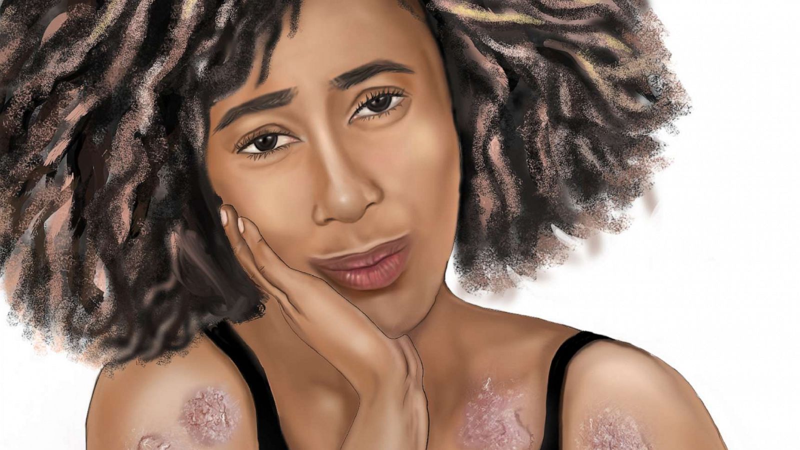 PHOTO: Illustrate Change's roll out of 25 diverse medical illustrations spotlighting darker complexion models includes psoriasis.