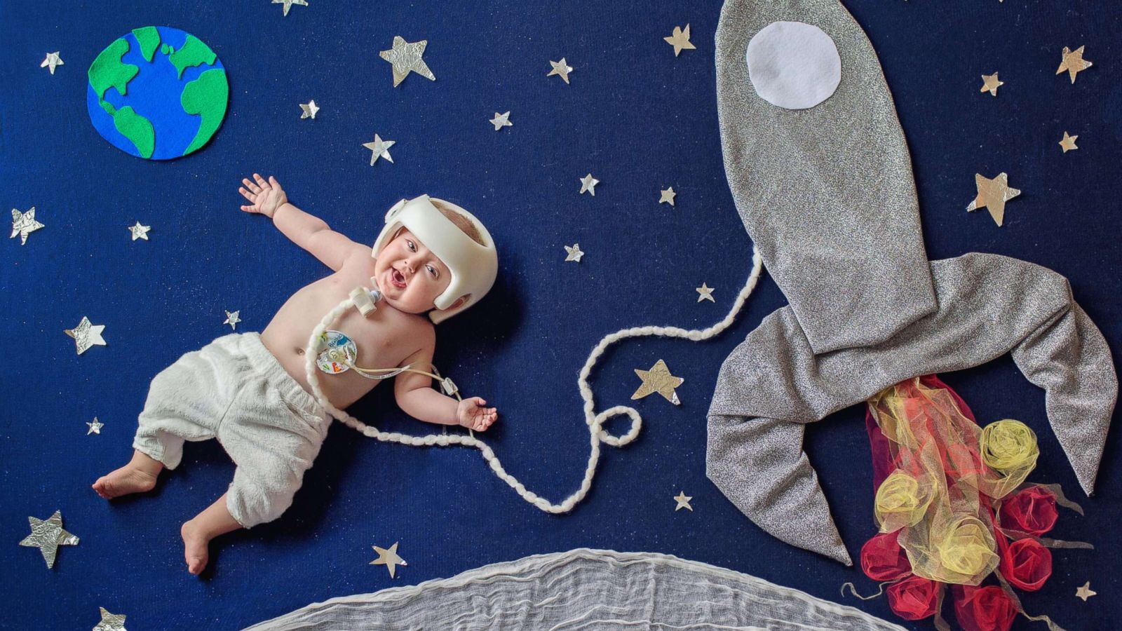 PHOTO: A baby with a tranche and a head shaping helmet is transformed into an astronaut for the Precious baby project.