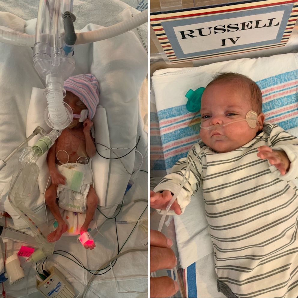 PHOTO: Russell Appold Jr. was treated at Tulane Lakeside Hospital in Louisiana, after his mother went into labor at 22 weeks pregnant. Russell fought 133 days in the NICU and finally arrived home Oct. 1.