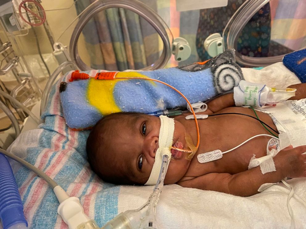 PHOTO: Curtis Means at UAB Hospital Birmingham, Ala. has been certified by Guinness World Records as the world's most premature baby to survive.
