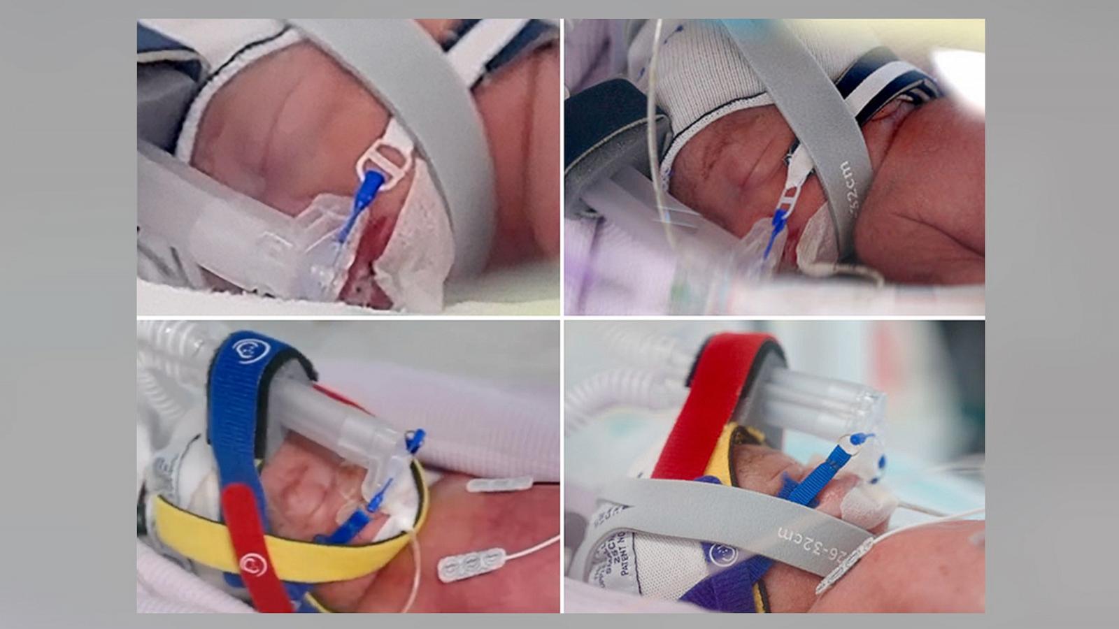 PHOTO: A woman gave birth to a identical quadruplet girls at Royal Brisbane and Women's Hospital in Queensland, Australia.