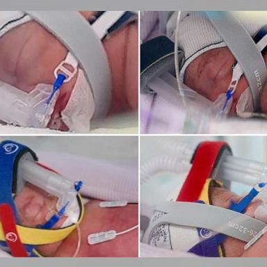 PHOTO: A woman gave birth to a identical quadruplet girls at Royal Brisbane and Women's Hospital in Queensland, Australia.