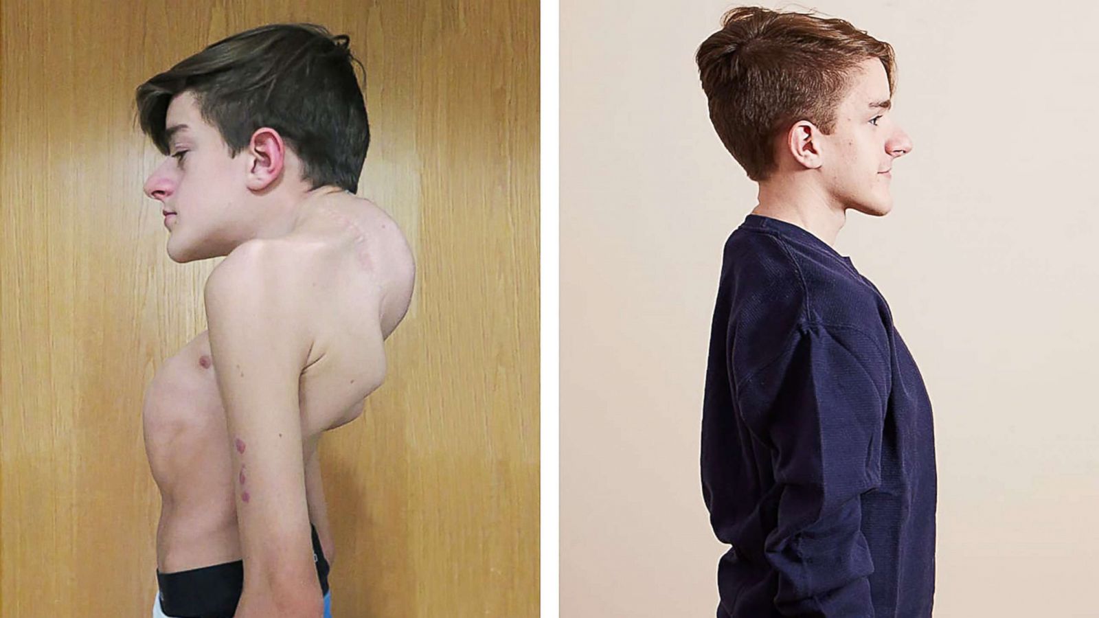 PHOTO: John Sarcona, 19, has had an unbelievable transformation since battling severe scoliosis.