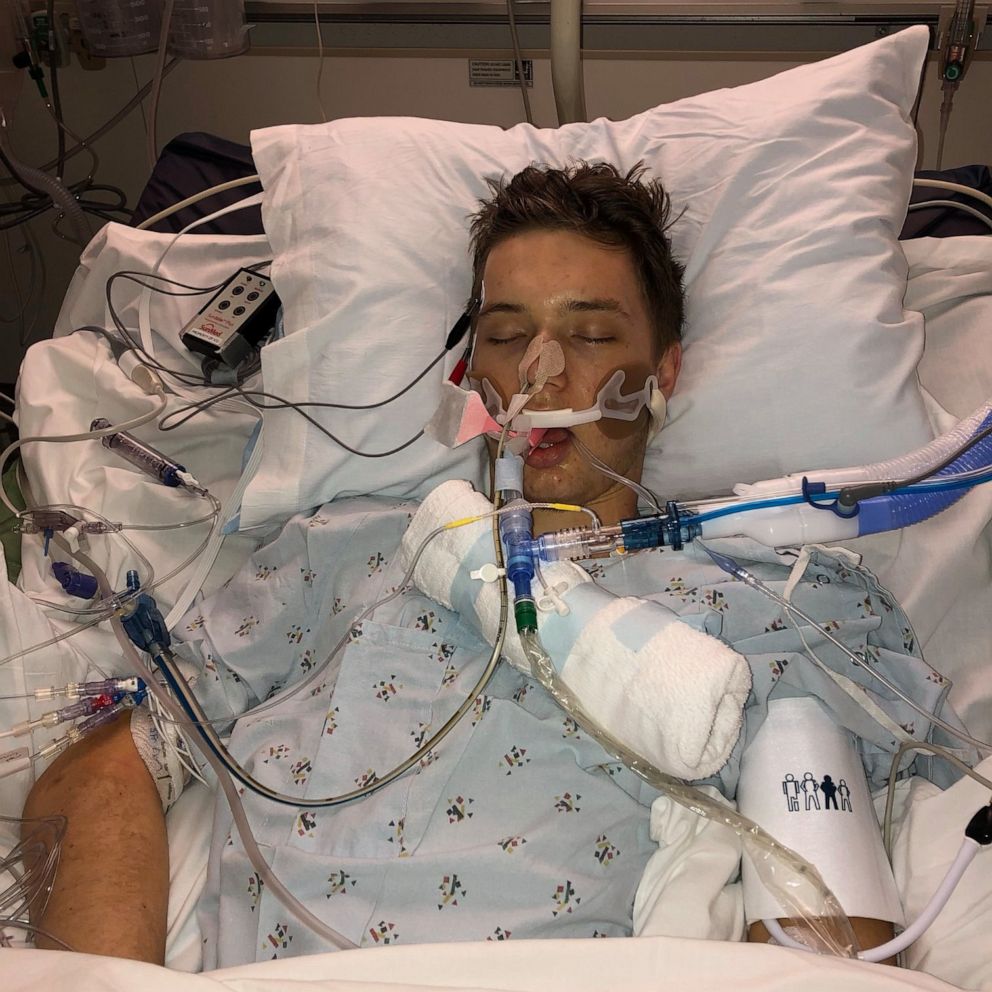 VIDEO: 21-year-old hospitalized in what doctor says was 'vaping-induced lung injury'
