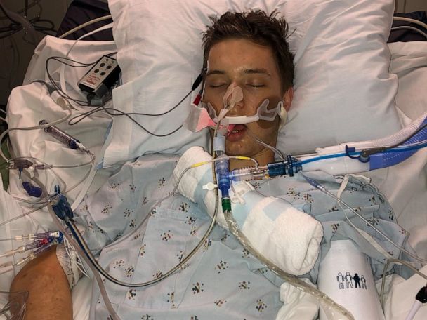 21 year old hospitalized in what doctor says was vaping induced lung injury