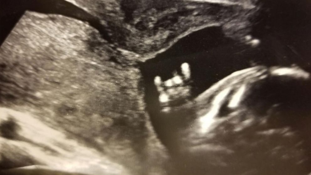 VIDEO: Texas A&M loving parents see rival school symbol in ultrasound