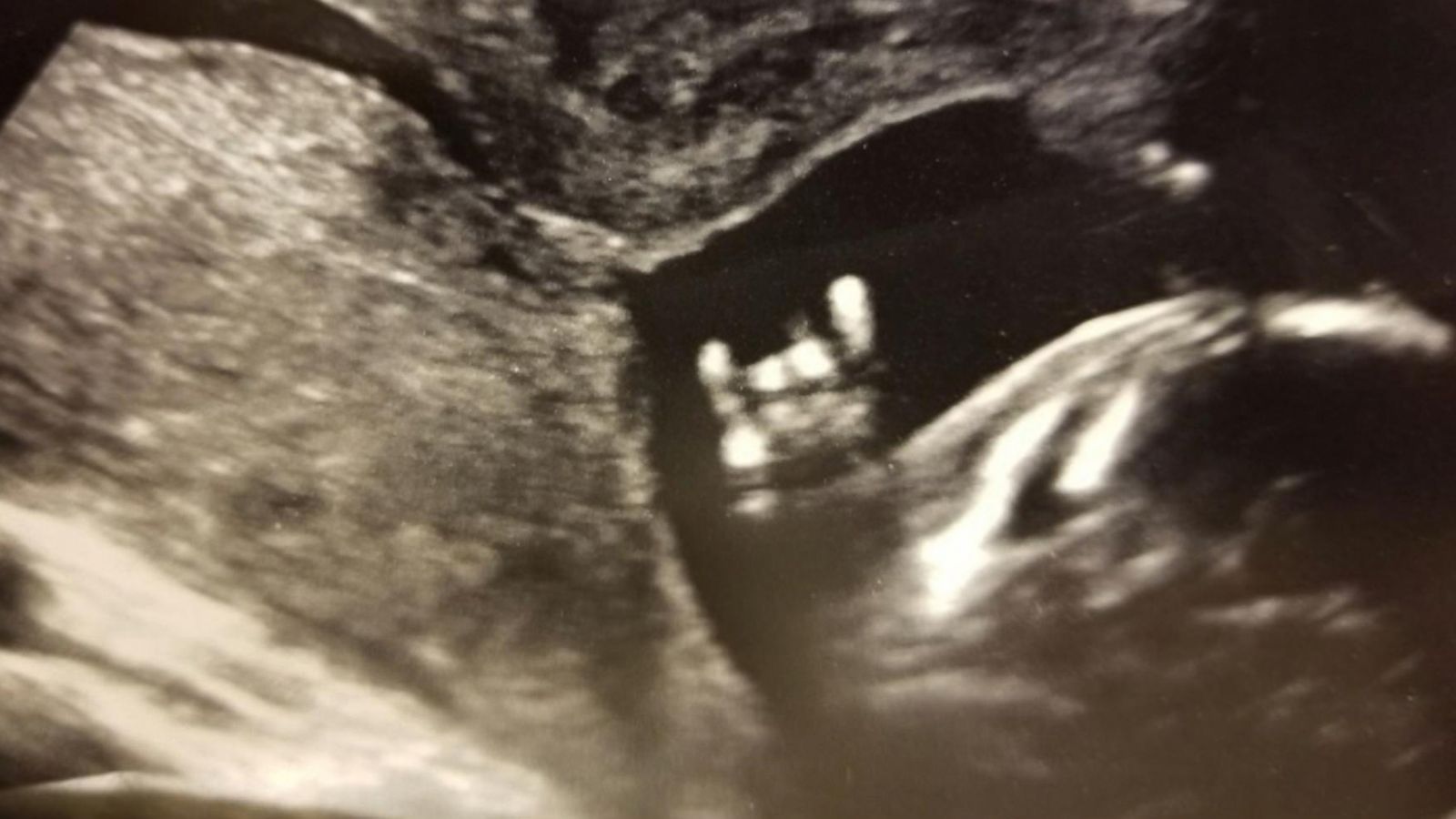 PHOTO: The Perkins family was shocked to see an ultrasound image that appeared to show their baby flashing what appears to be "hook 'em horns" -- the hand sign of their major rival, the University of of Texas Longhorns.