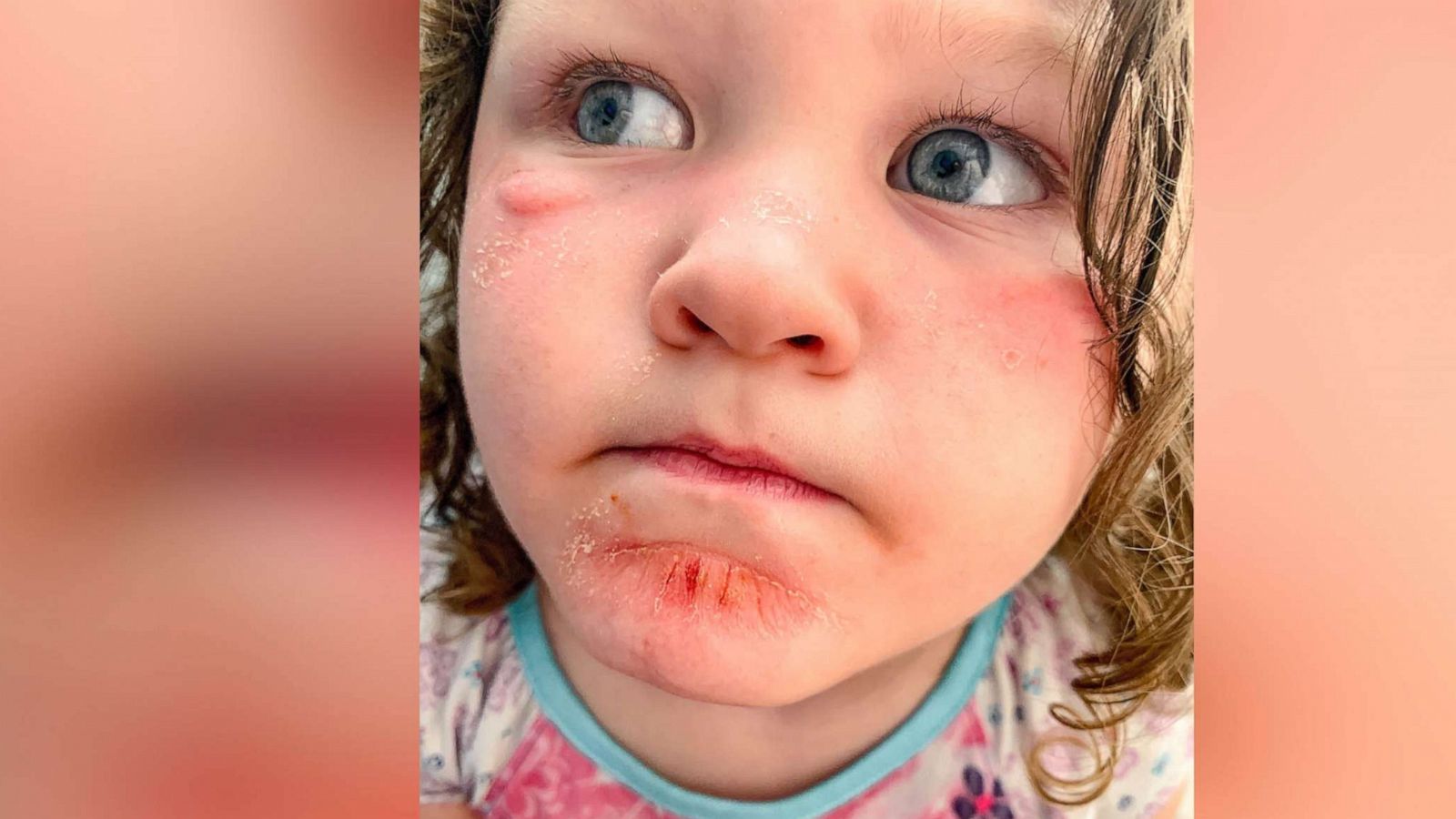 PHOTO: Megan Doss, a mother of three from Georgia, shared an image with her 11,500 Instagram followers of her daughter Caroline, 3, from Aug. 1, 2020 when she had an apparent allergic reaction to sunscreen.