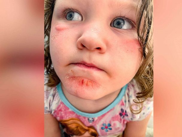 Mom posts sunscreen PSA after daughter develops reaction - Good Morning America