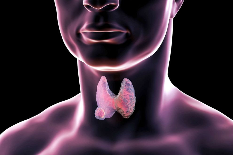PHOTO: A stock illustration of a Thyroid gland tumor.