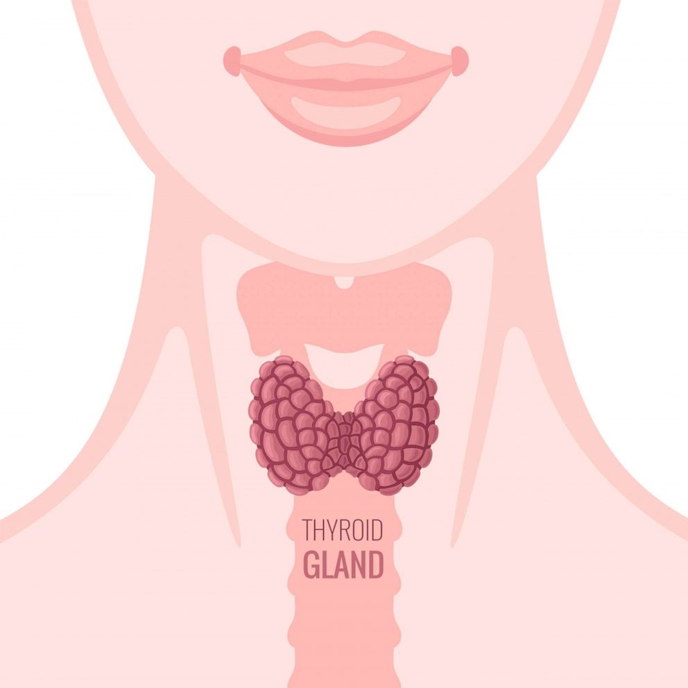 PHOTO: A Thyroid gland on a woman silhouette is seen in this graphic illustration.