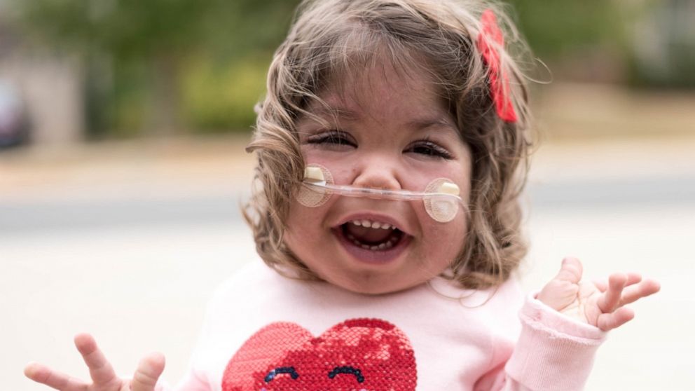 PHOTO: Emmett Hightshoe was diagnosed with Kabuki syndrome in utero. It’s a rare genetic disorder impacting organ development, as well as her physical and cognitive abilities.