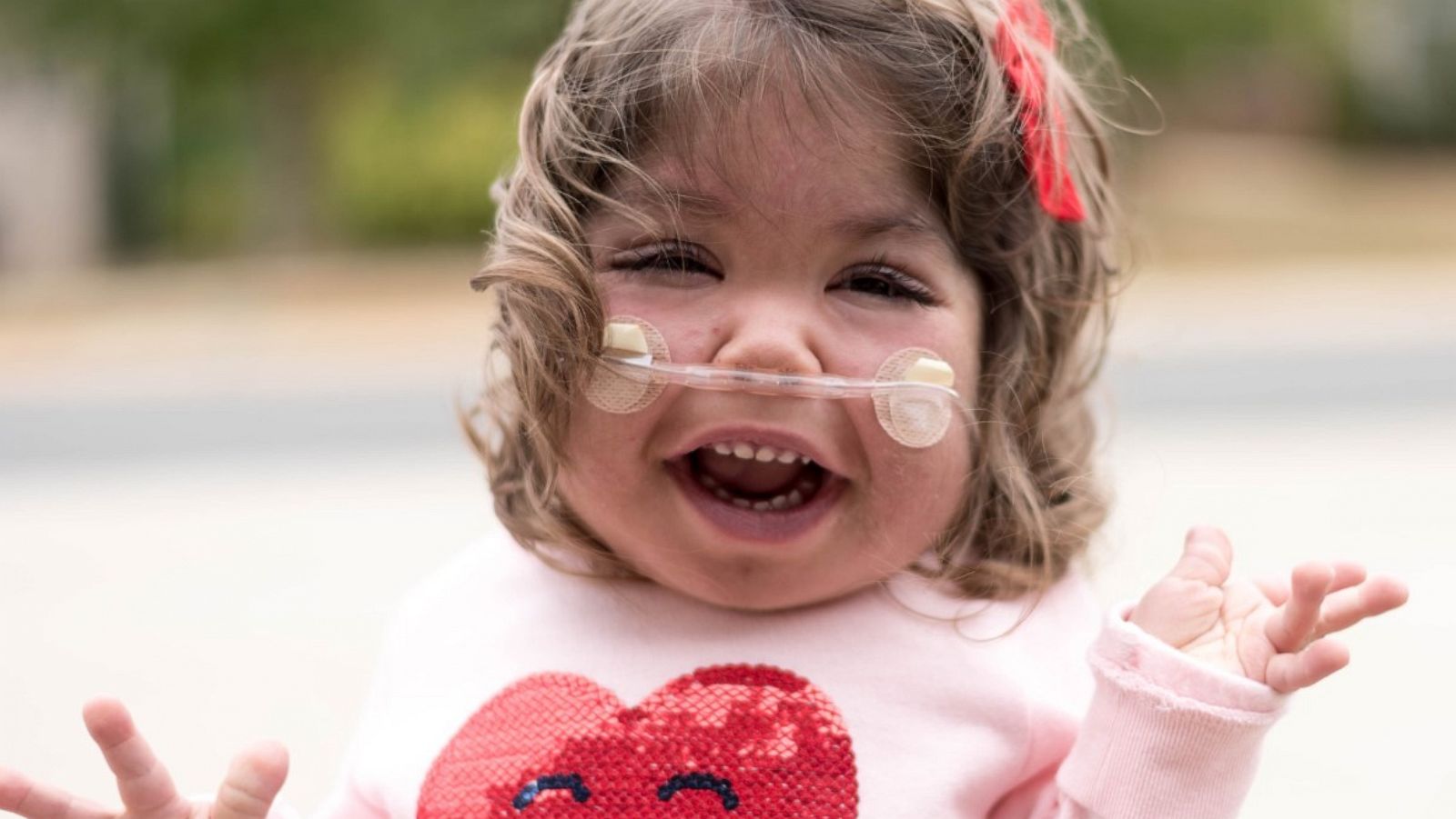 PHOTO: Emmett Hightshoe was diagnosed with Kabuki syndrome in utero. It’s a rare genetic disorder impacting organ development, as well as her physical and cognitive abilities.