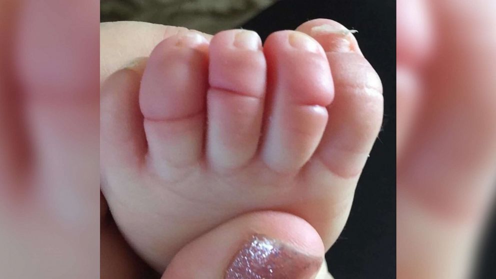 Mom's photo of baby's swollen foot sparks awareness about rare condition -  ABC News